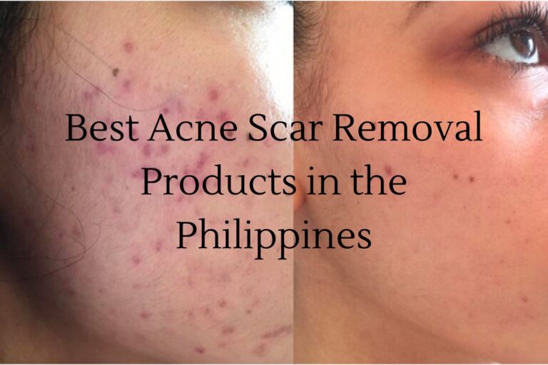 Top 5 Best Acne Scar Removal Products in the Philippines Your Guide to